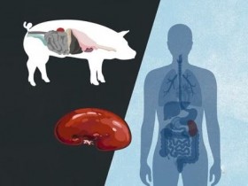 全球首例猪肾移植患者不到2个月死亡