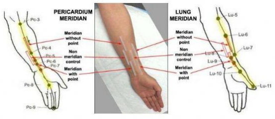 Mechanism-acupuncture