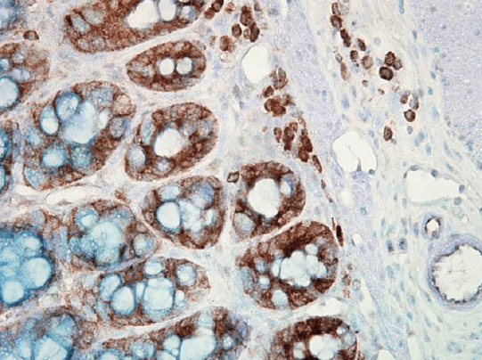 抗Hsp90单克隆抗体对人结肠癌的免疫组化分析
