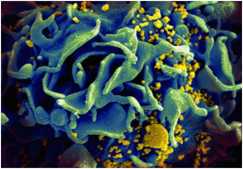 受HIV感染的T细胞的扫描电镜图