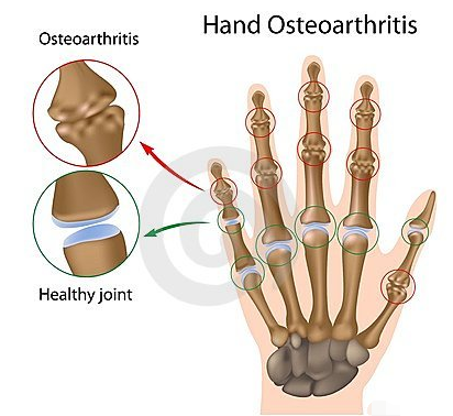 手部骨关节炎