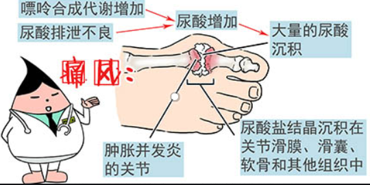 痛风发病