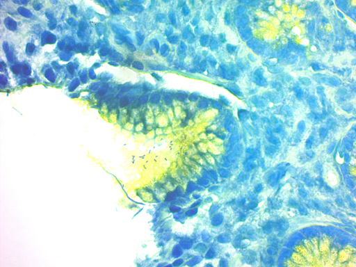 幽门螺杆菌感染的胃组织切片