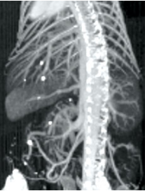 注射AuroVist 15 nm X射线造影剂后小鼠体内显微CT。