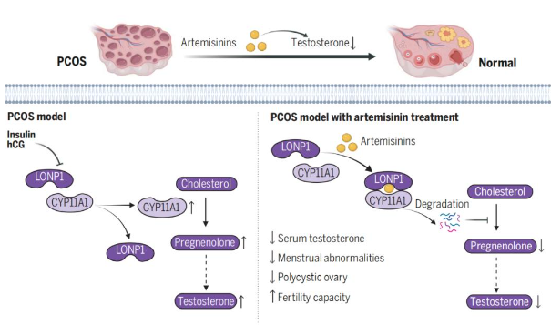 PCOS